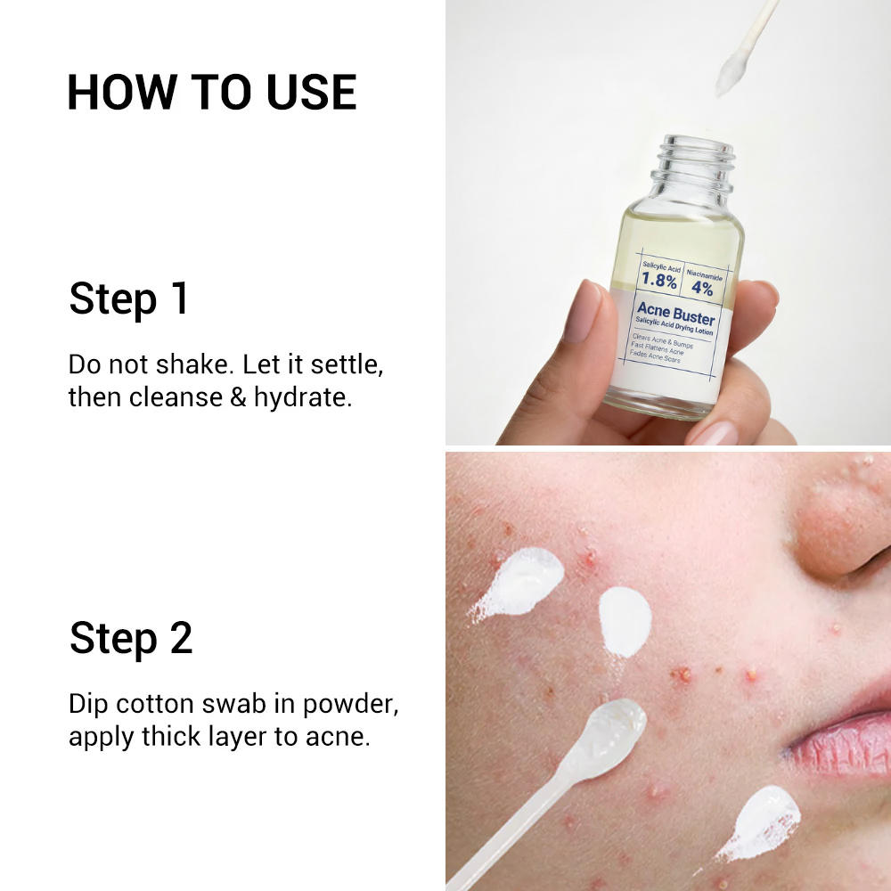 Clear Acne Overnight (Without Harsh Chemicals)