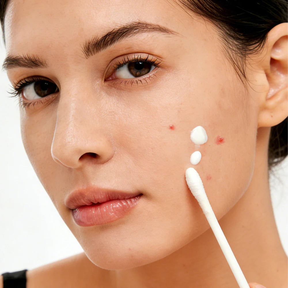Clear Acne Overnight (Without Harsh Chemicals)