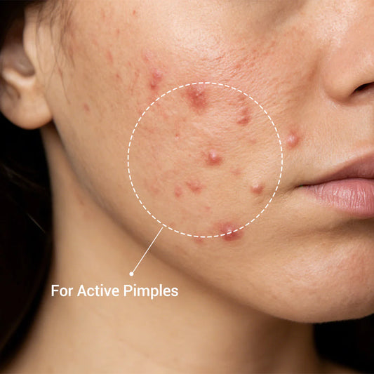 Clear Acne Overnight (Without Harsh Chemicals)
