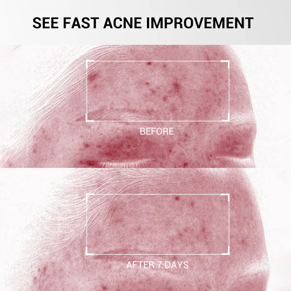 Clear Acne Overnight (Without Harsh Chemicals)